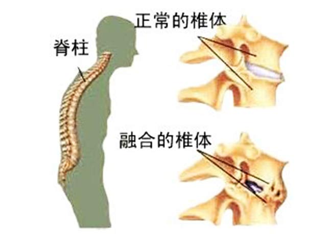 強直性脊柱炎 貴陽烏當區康骨堂【官網】|北京康骨堂貴陽中醫養生館